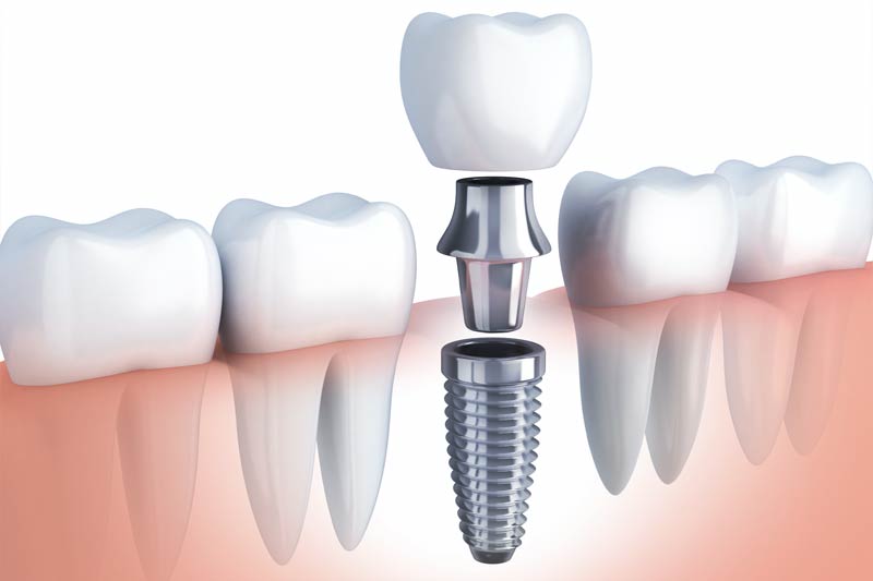 Dental implant consultation at Hometown Dental Co.