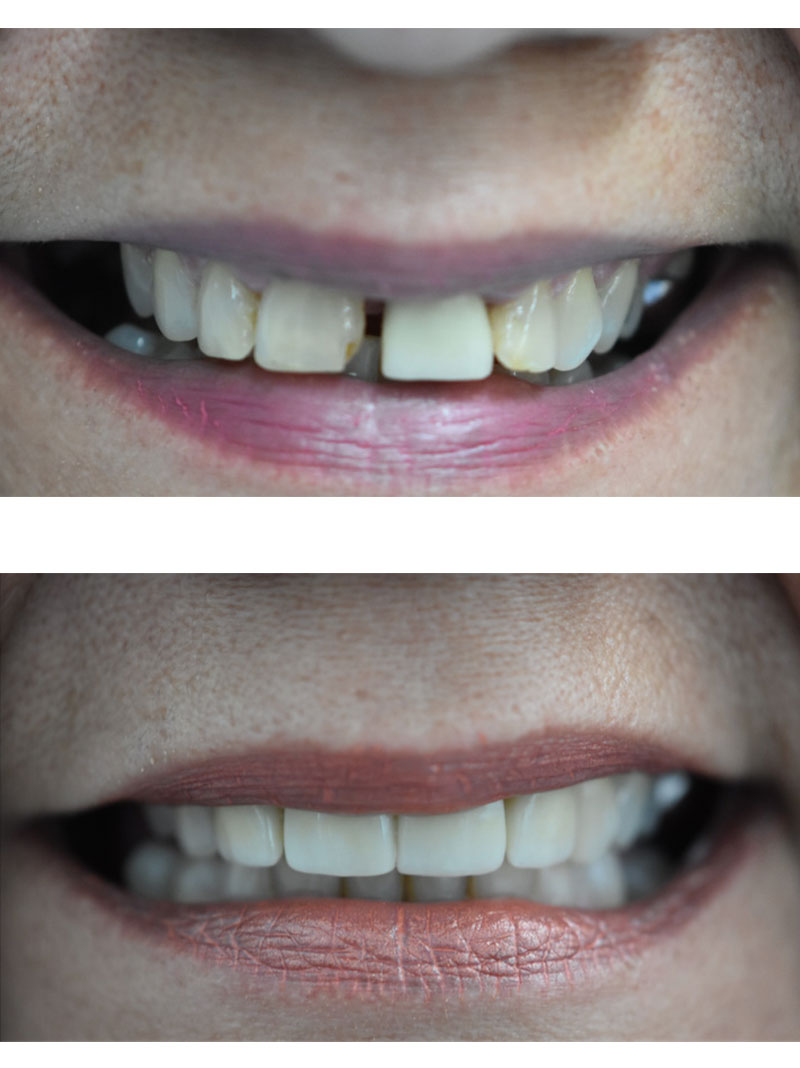 Hometown Dental Co. before-and-after treatment result