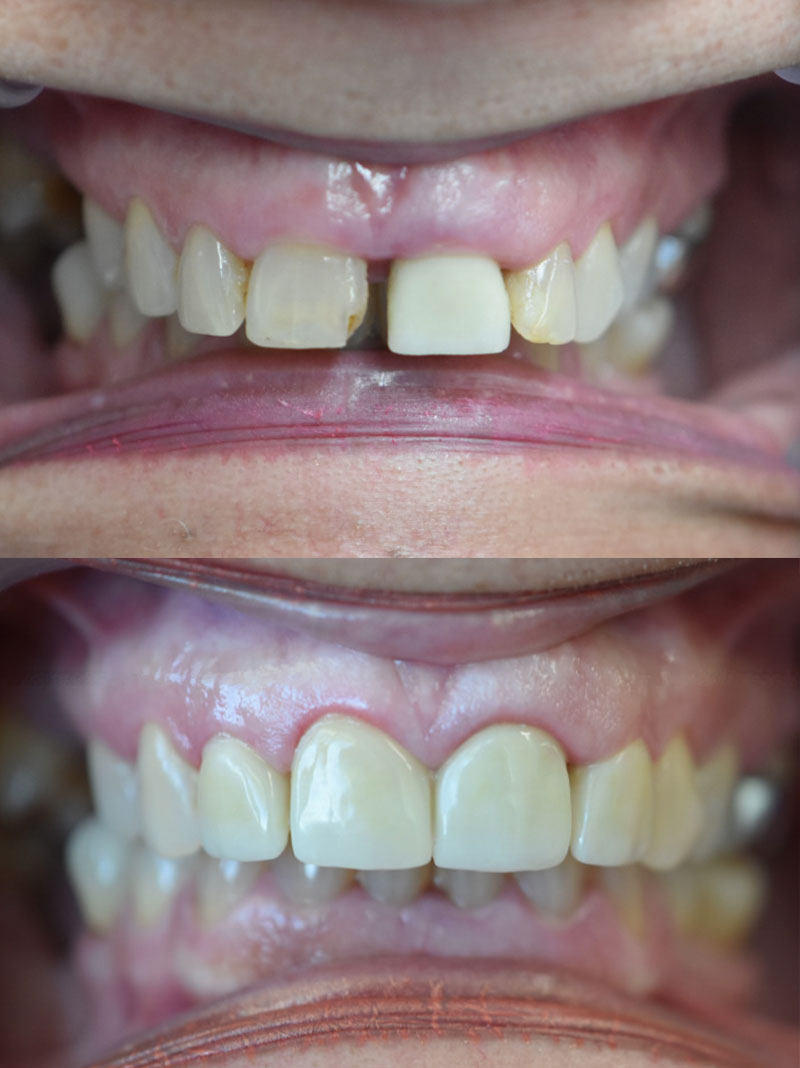 Hometown Dental Co. before-and-after treatment result