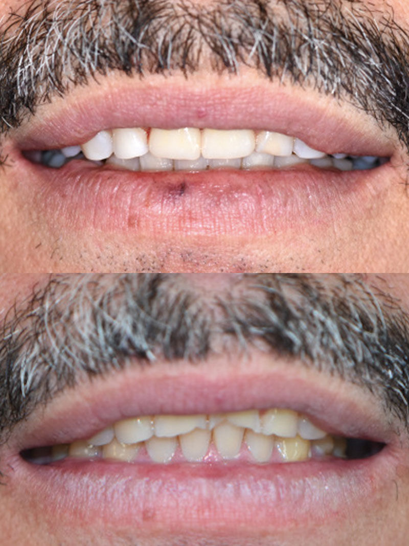 Hometown Dental Co. before-and-after treatment result