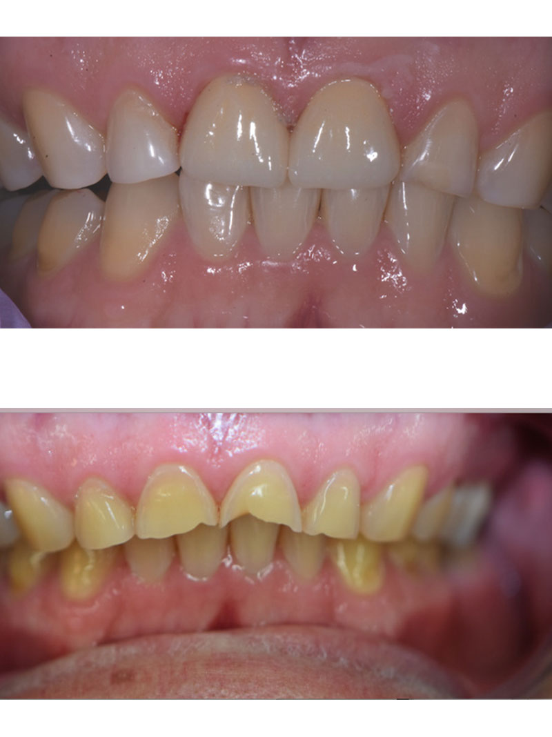Hometown Dental Co. before-and-after treatment result