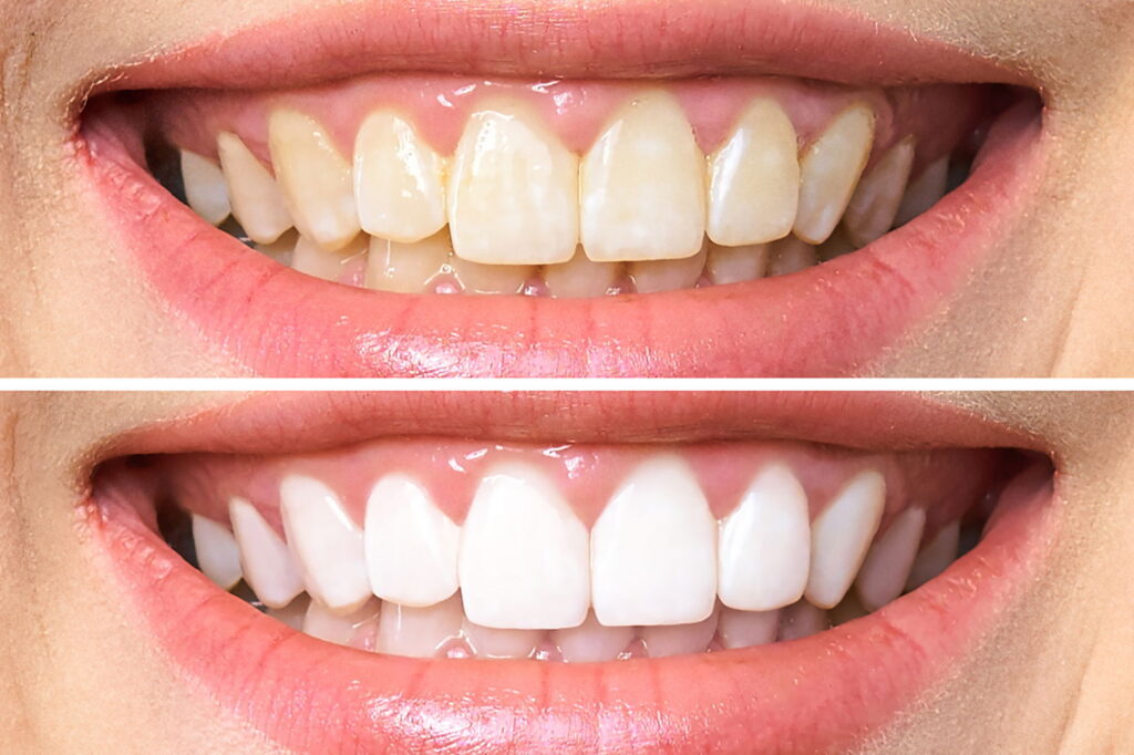 teeth-cleaning-exam4