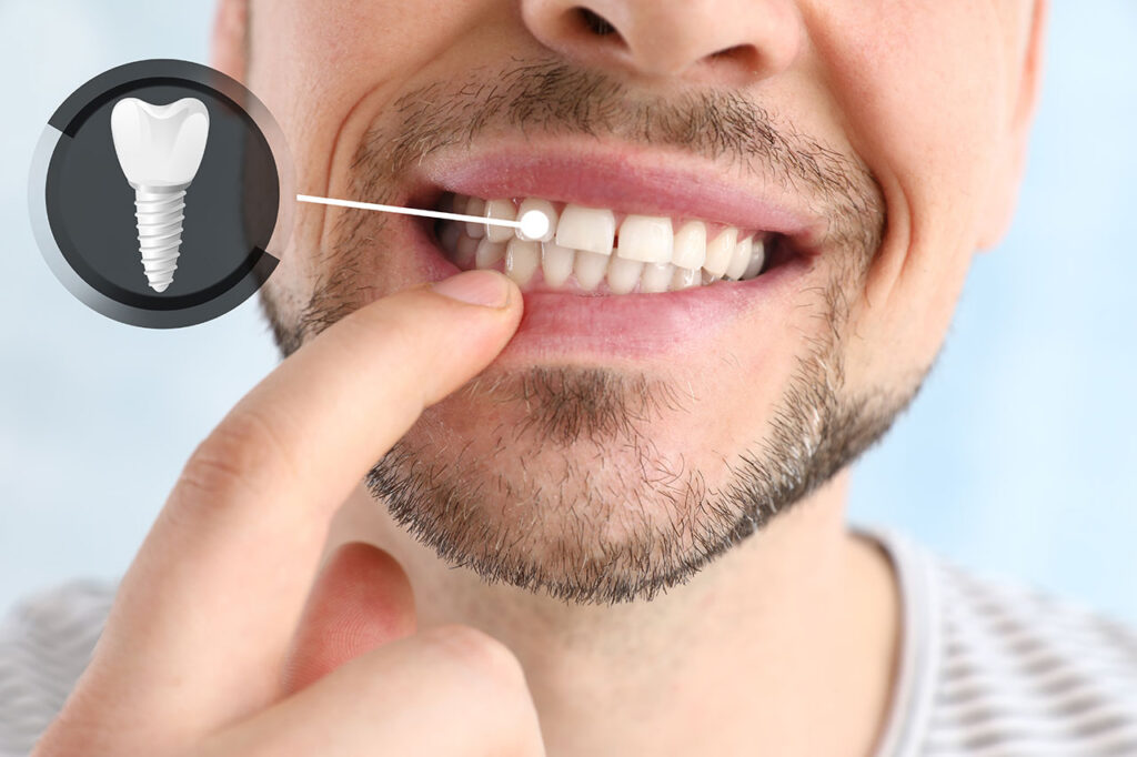 Single-Tooth Dental Implants in Bastrop, TX: A Complete Guide to Replacing One Missing Tooth